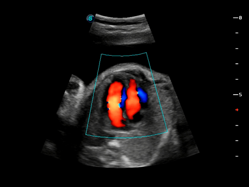 胎儿四腔心血流